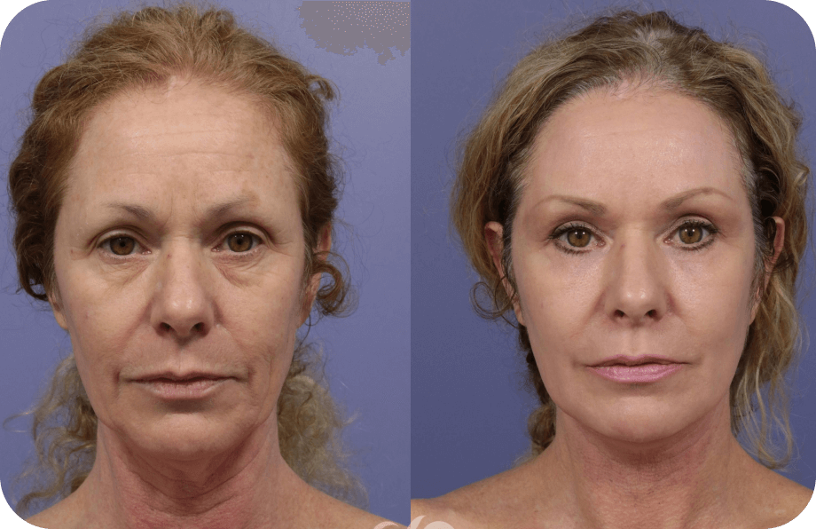 Synevra UltraLift™ Review | Benefits, Ingredients & Results