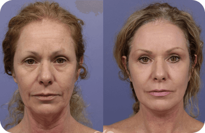 Synevra UltraLift™ Review | Benefits, Ingredients & Results